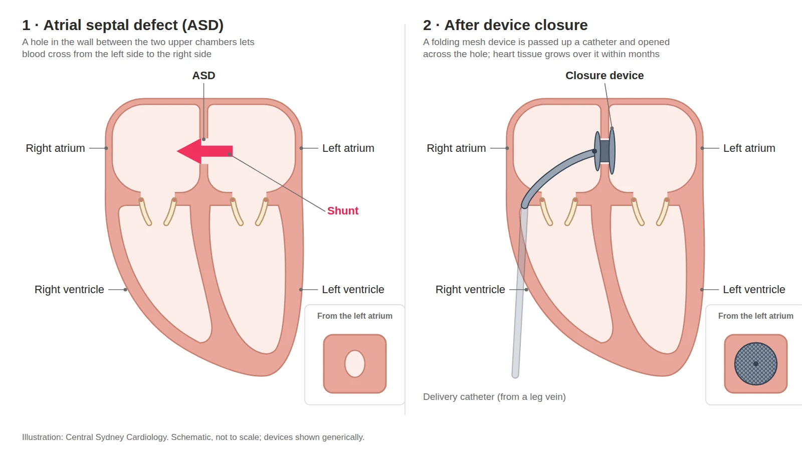 Two-panel diagram: a hole between the two upper chambers of the heart with blood crossing it, then the hole covered by a double-disc closure device