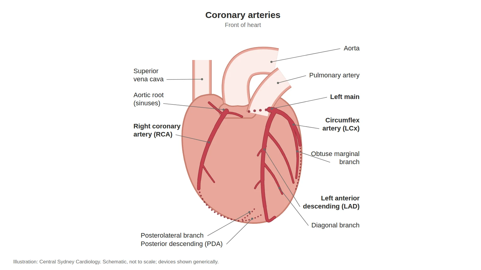 Diagram of the coronary arteries on the front of the heart, with the right coronary, left main, left anterior descending and circumflex arteries labelled