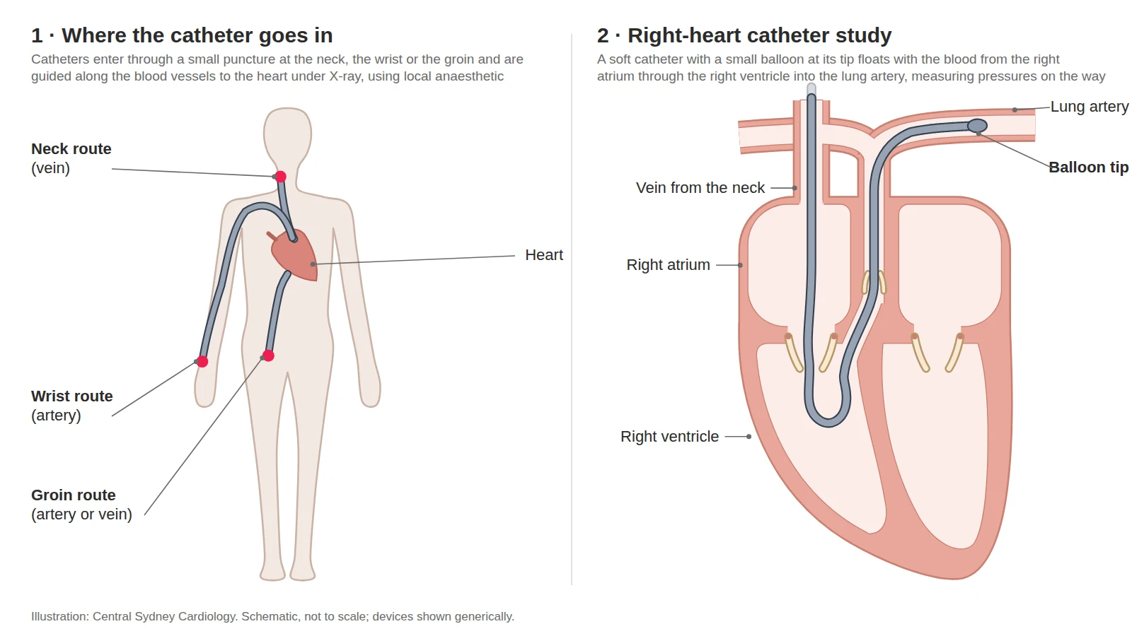 Two-panel diagram: the three catheter entry points on the body, then a balloon-tipped catheter passing through the right heart into the lung artery