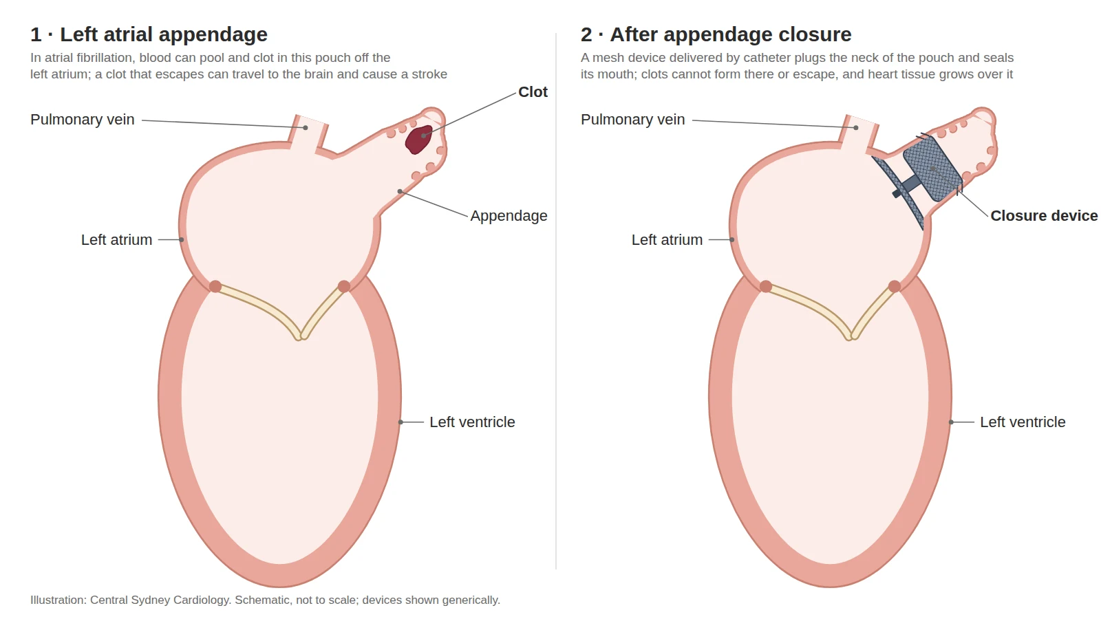 Two-panel diagram: a clot forming in the left atrial appendage, then the appendage sealed by a closure device