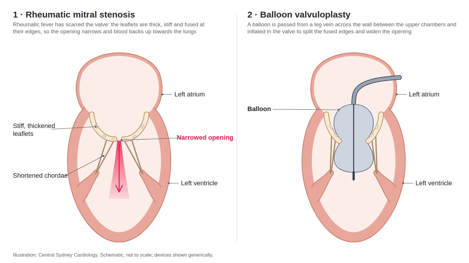Two-panel diagram: a narrowed rheumatic mitral valve, then a balloon inflated across it to open the fused leaflets