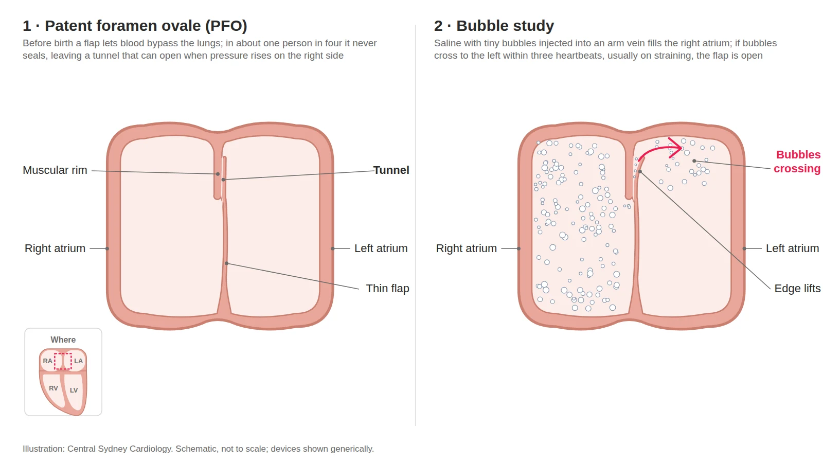 Two-panel diagram: a patent foramen ovale between the upper chambers, then a bubble study with bubbles crossing to the left side as the flap lifts