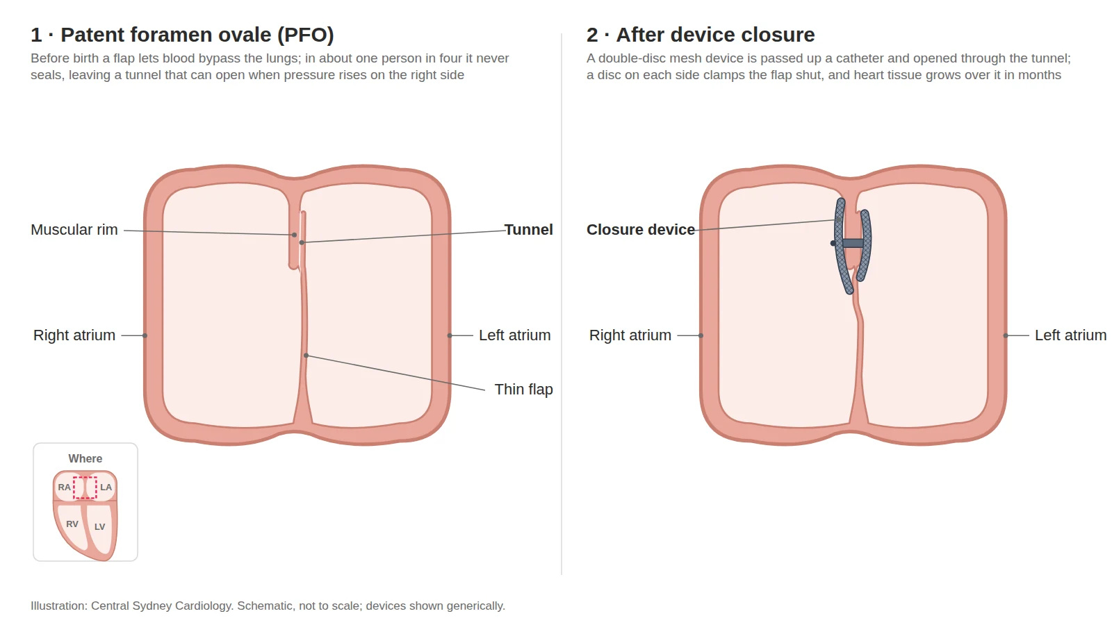 Two-panel diagram: a patent foramen ovale, then the flap held shut between the two discs of a closure device