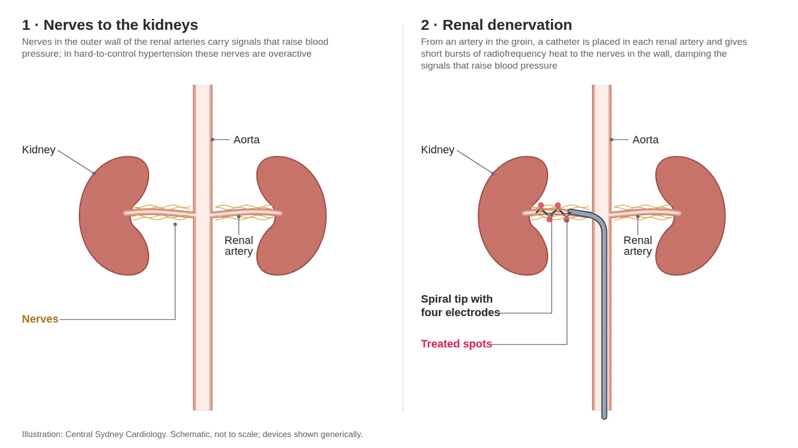 Two-panel diagram: nerves running along a renal artery, then a catheter treating those nerves from inside the artery