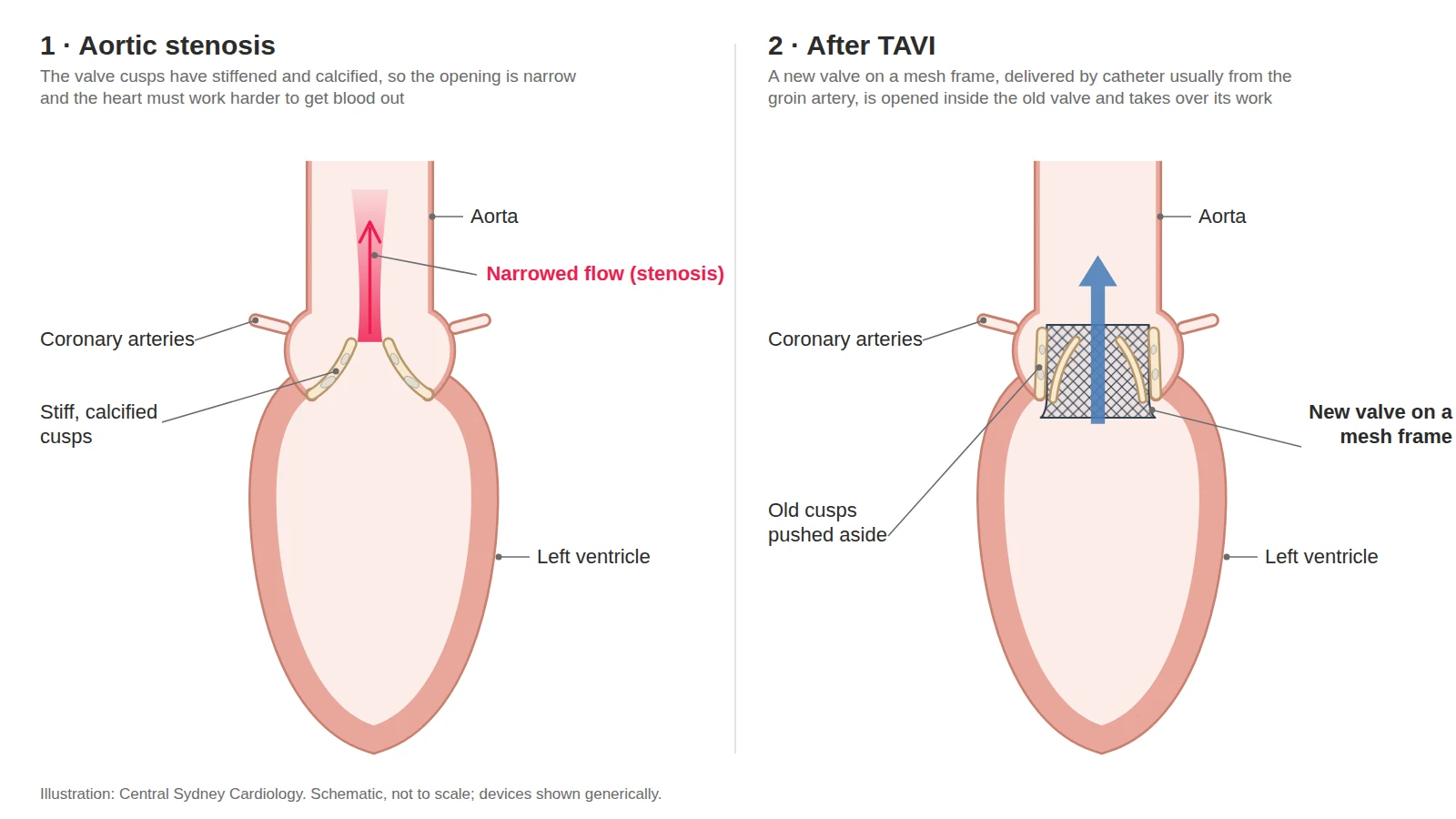 Two-panel diagram: a narrowed aortic valve, then a replacement valve expanded inside it