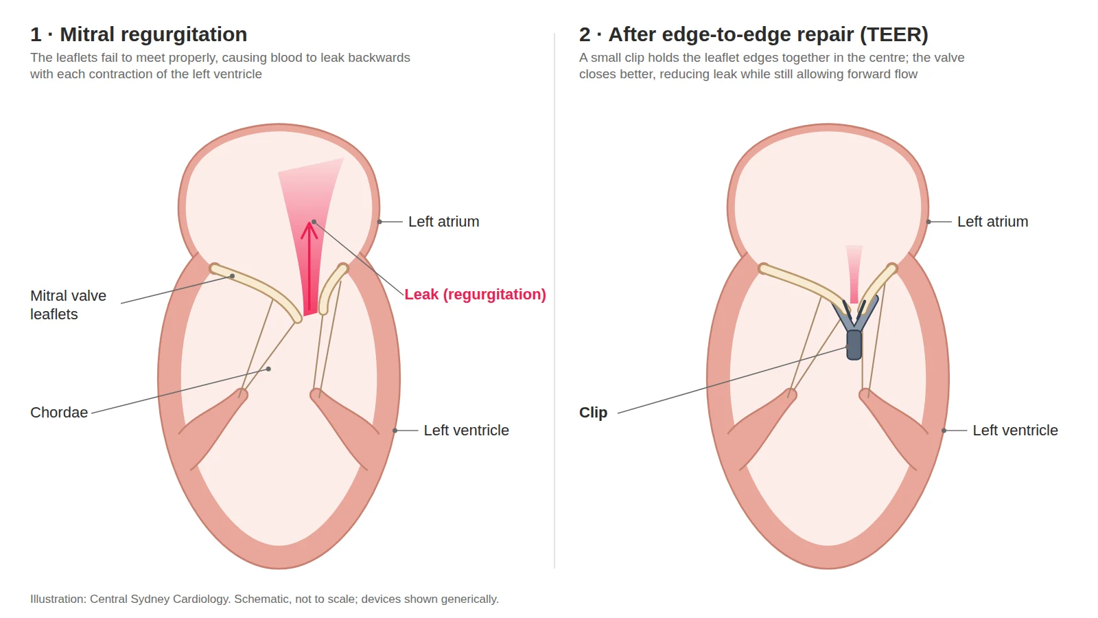 Two-panel diagram: a leaking mitral valve, then the same valve after a clip is placed on the leaflets to reduce the leak