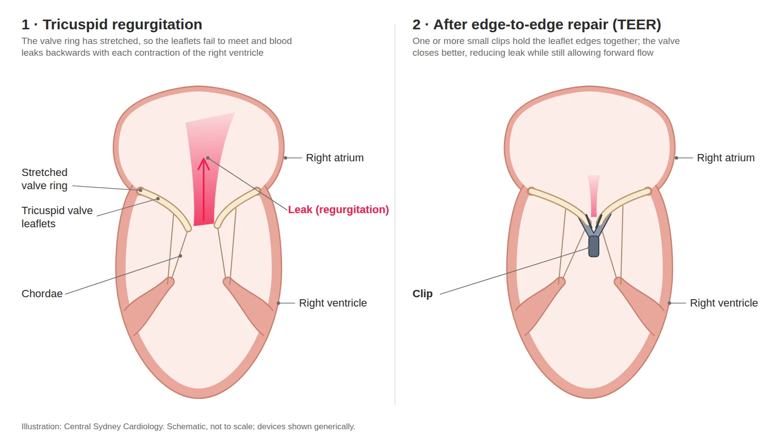 Two-panel diagram: a leaking tricuspid valve, then the same valve after a clip is placed on the leaflets